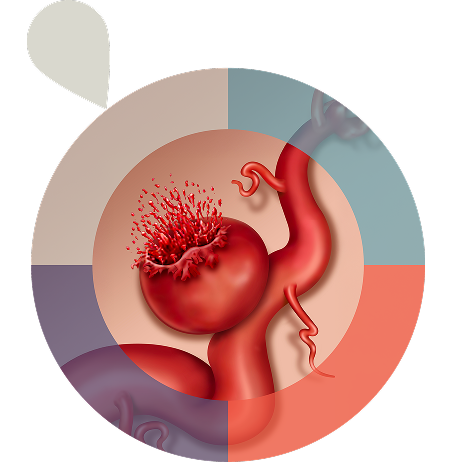 Aneurysmal rupture
